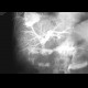 Biliary T-drain, drain into liver abscess, fistulography: RF - Fluoroscopy